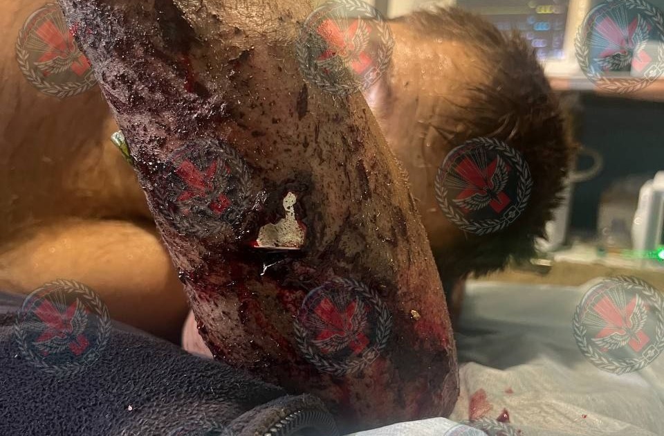 Тульские медики достали неразорвавшийся снаряд из руки военнослужащего