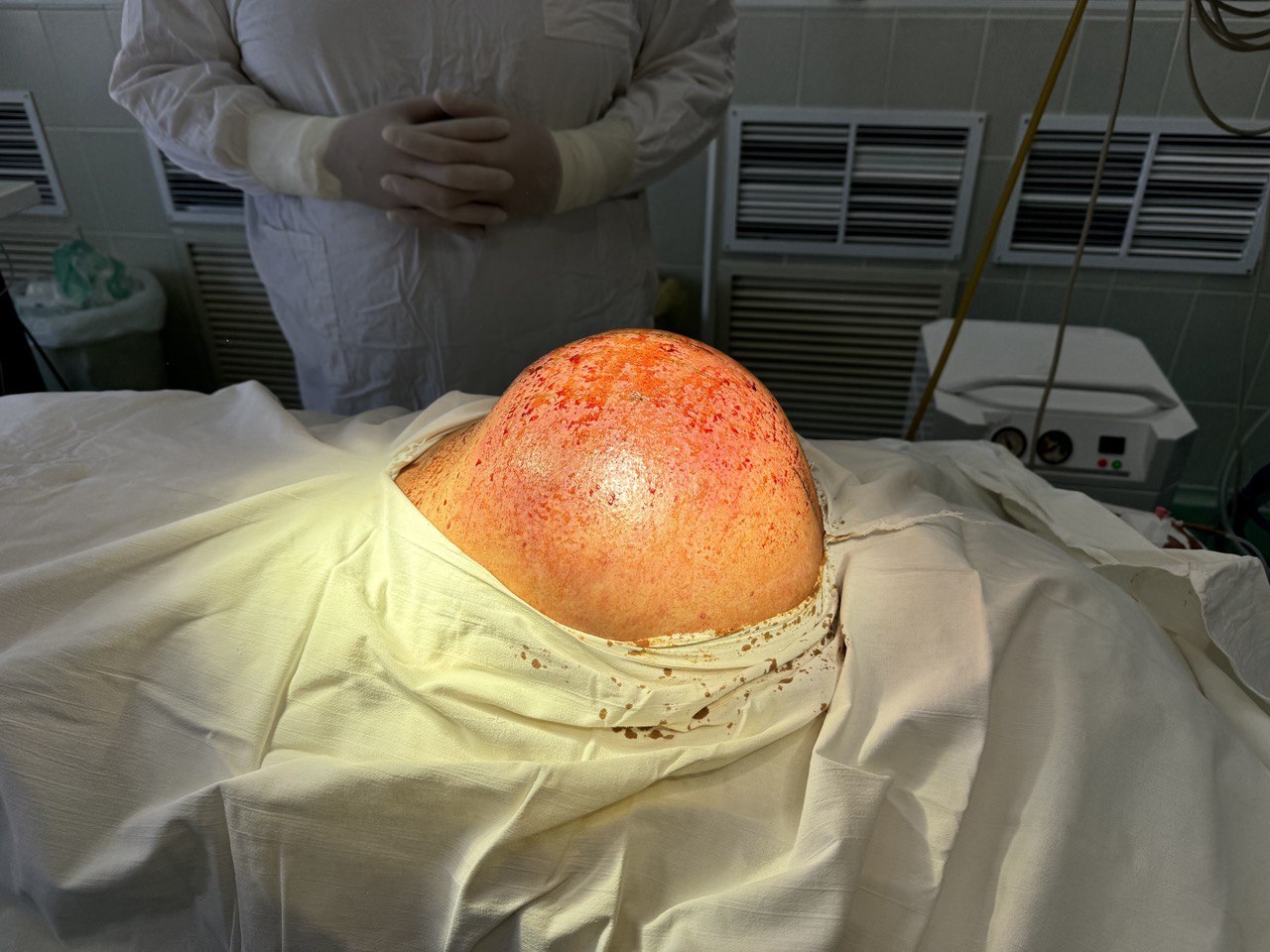 Тульские врачи удалили 4-килограммовую опухоль позвоночника
