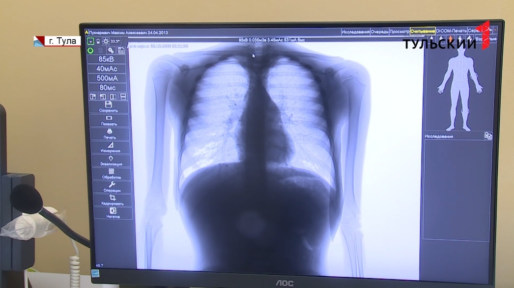 В тульской больнице установили новый рентген-аппарат за 13 млн рублей