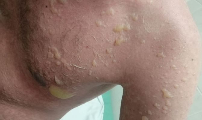 Тульские врачи спасли пациента с опасной для жизни аллергической реакцией