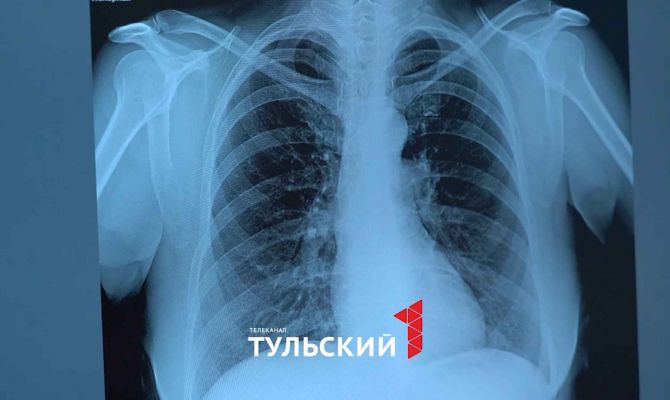 Врач объяснила, как изменились симптомы туберкулеза за 100 лет