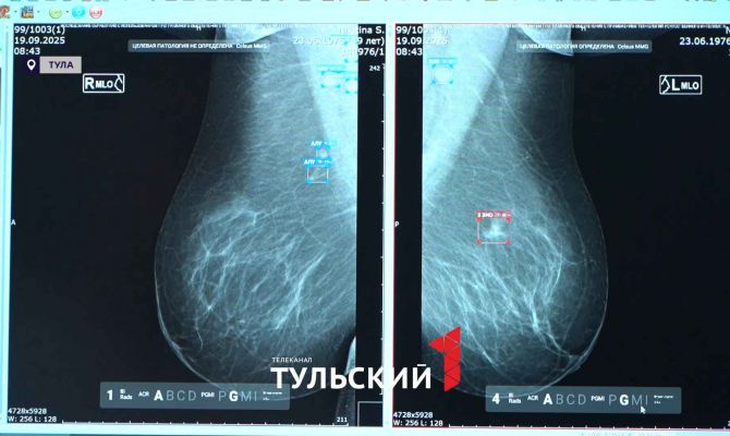 В Туле искусственный интеллект помогает выявлять рак молочной железы на ранней стадии