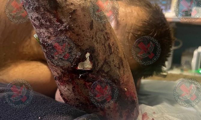 Тульские медики достали неразорвавшийся снаряд из руки военнослужащего