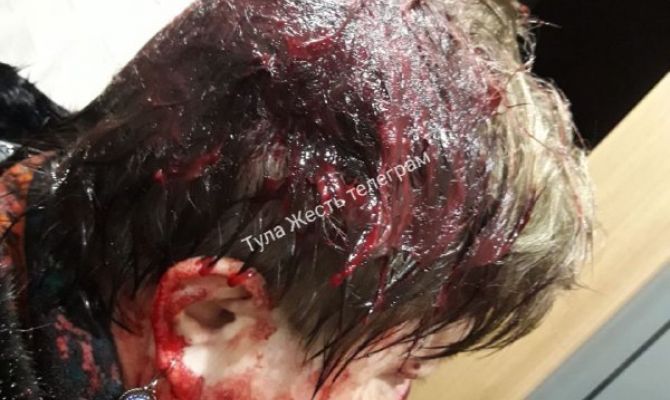 В Туле избитая лопатой врач-педиатр получила рваные раны головы