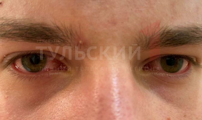 Ослепительный сервис: в Туле подростки получили ожоги глаз и лица после посещения кофейни