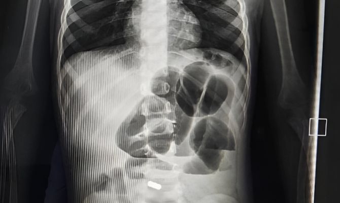 Тульские хирурги спасли 2-летнего ребенка, проглотившего магниты