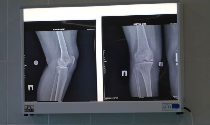 В Тульской области помолодели болезни суставов