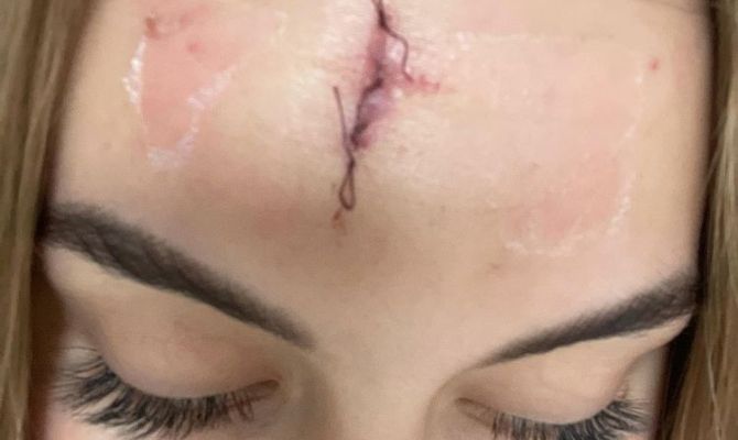 Тулячка отправилась в караоке-бар отдохнуть и вернулась с разбитым лицом