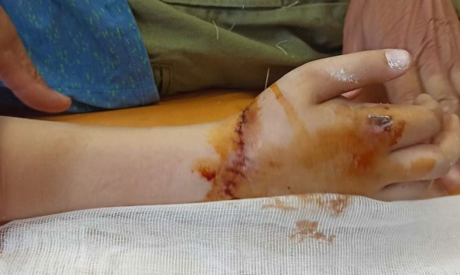 10-летнему туляку чуть не отрезало руку на аттракционе: уголовное дело вернули прокурору