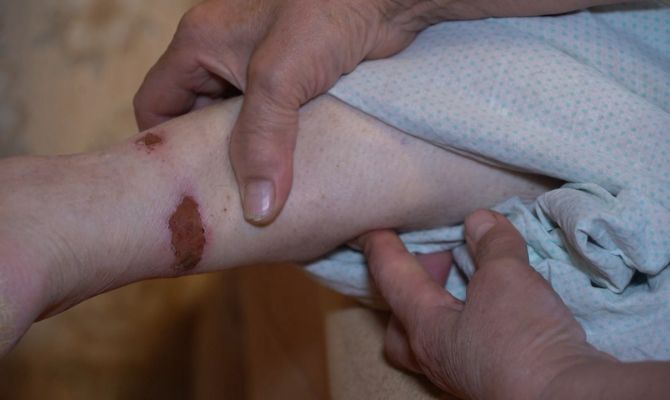 В больнице Новомосковска пенсионера привязали к кровати: прокуратура огласила результаты проверки