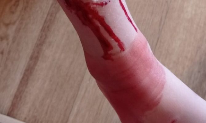 В Новомосковске от укуса собаки пострадал ребёнок