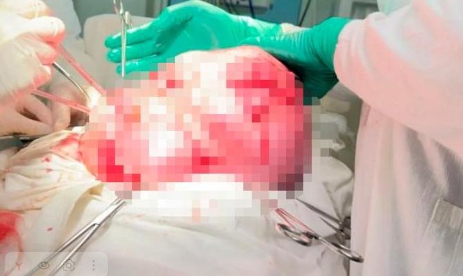 Хирурги удалили тулячке опухоль весом 14 килограммов