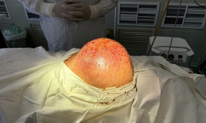 Тульские врачи удалили 4-килограммовую опухоль позвоночника