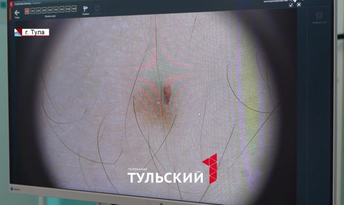 Дерматолог назвала безопасное число родинок на теле