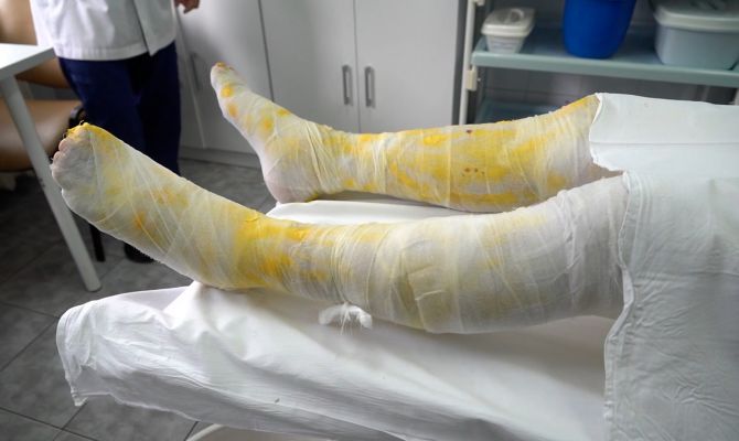 Как нельзя лечить ожог: врачи назвали основные ошибки