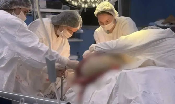 Онкологи из Тулы удалили пациентке опухоль весом 35 кг