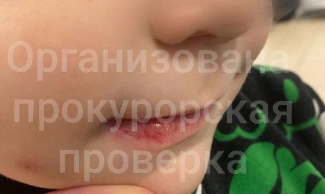 В Новомосковске воспитателя детского сада обвиняют в избиении ребенка