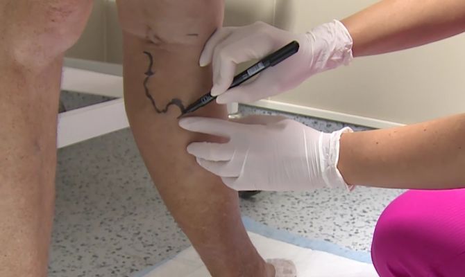 Главный врач тульского онкоцентра объяснил, почему появляется варикоз