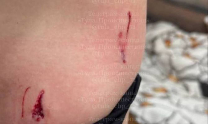 В Щекинском районе на 7-летнюю девочку напали бродячие собаки: прокуратура начала проверку