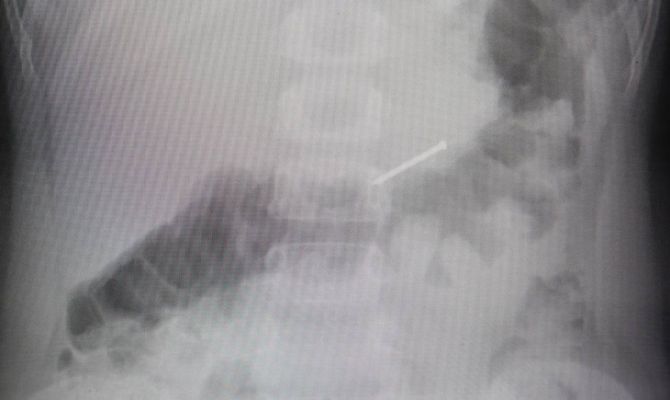 Названы неочевидные признаки, что ваш ребенок что-то проглотил