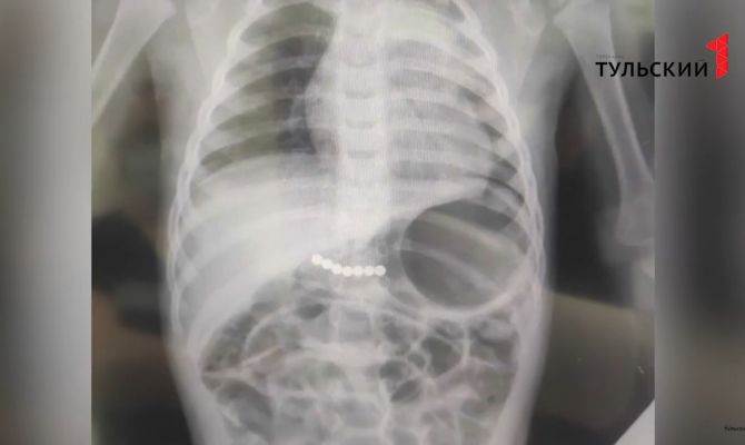 Что находят детские хирурги в желудках маленьких туляков