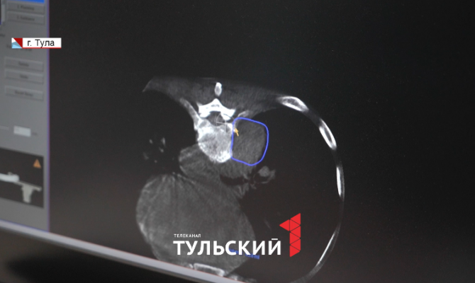 В тульском онкоцентре начали делать 3D-модели раковых опухолей