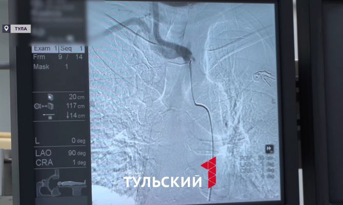 Врачи в Туле начали проводить стентирование сонных артерий