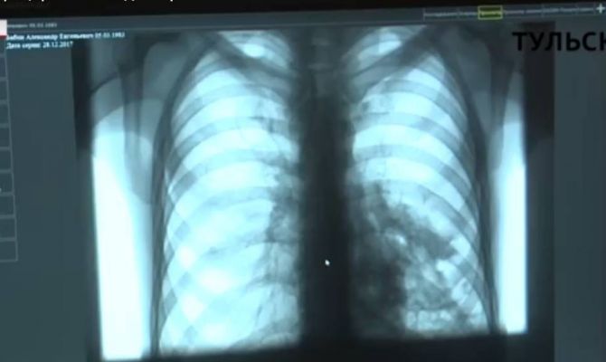 Туберкулез: инфицирован каждый третий заключенный