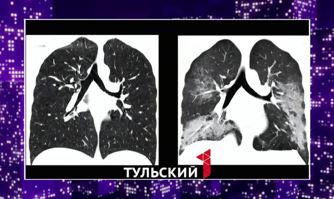 Главный пульмонолог Тульской области объяснил феномен "попкорновой болезни"