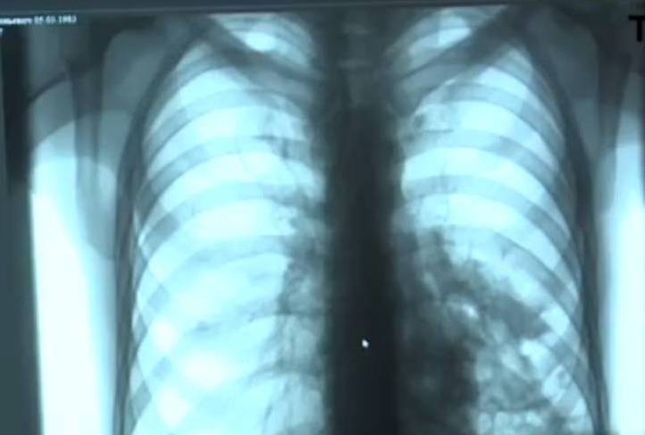 В Туле пациент с туберкулезом сбежал из диспансера