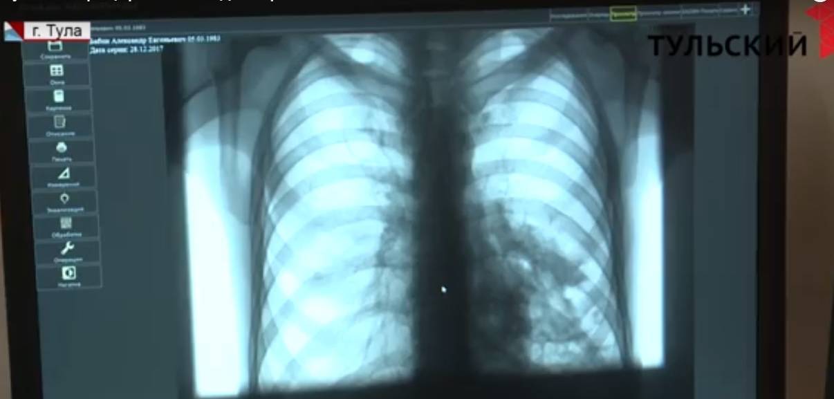 В Киреевске четырех больных туберкулезом отправят на принудительное лечение