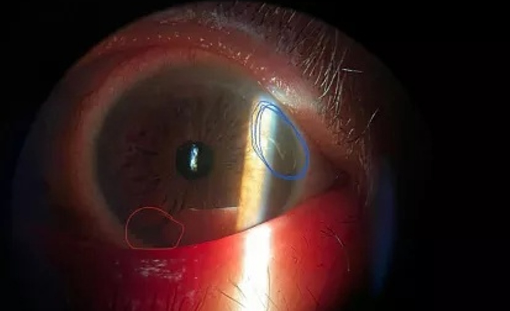 Тульские врачи спасли зрение мужчине с куском металла в глазу